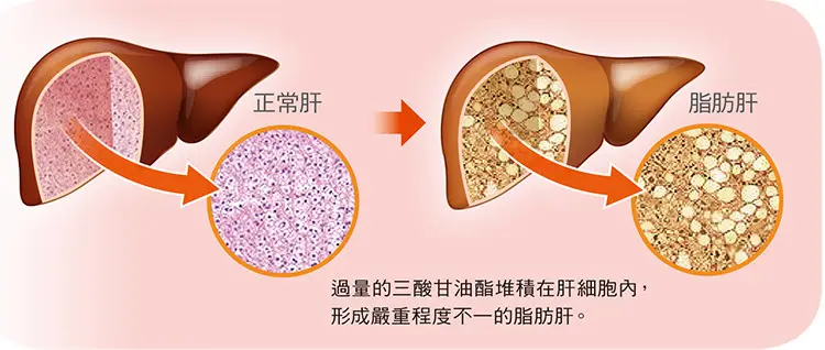 脂肪肝是怎么回事