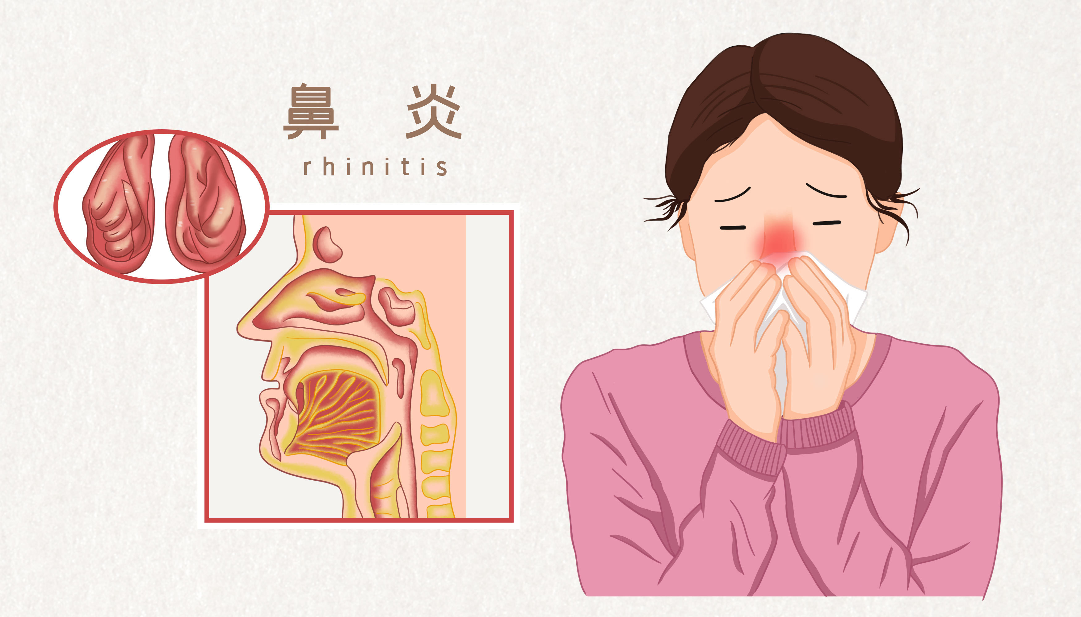 一篇文章带你了解鼻炎！