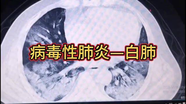 出现4种征兆，病毒可能已经侵犯你的双肺了！